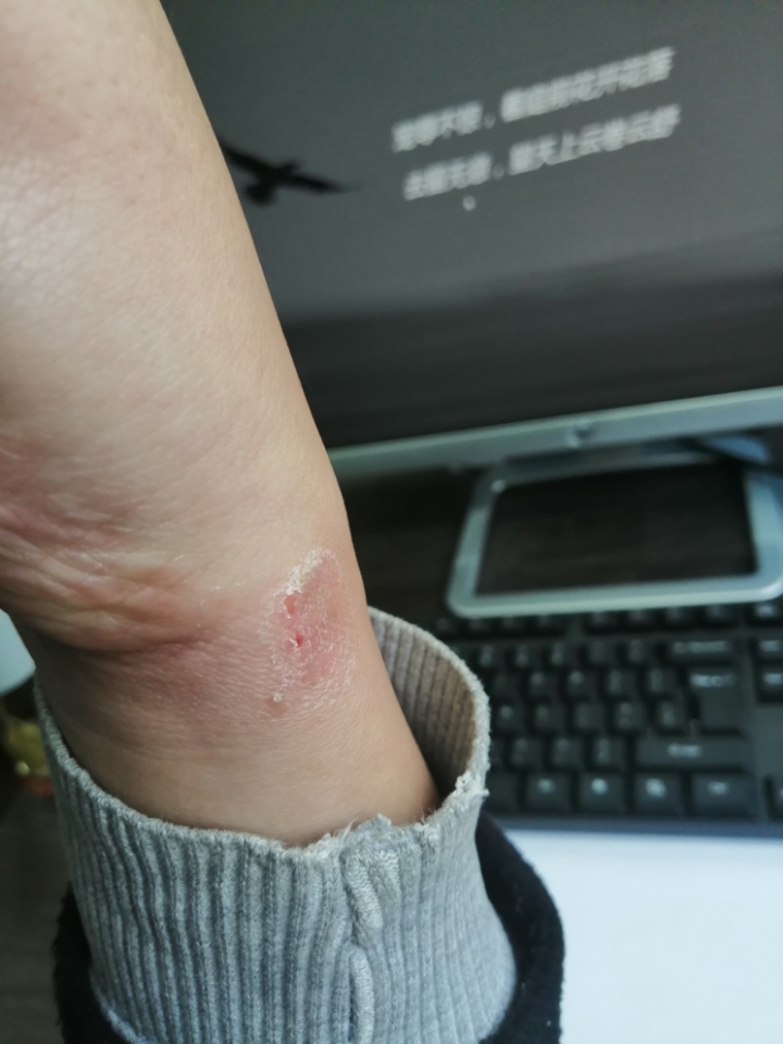 荣耀手环4佩戴过敏红肿脱皮